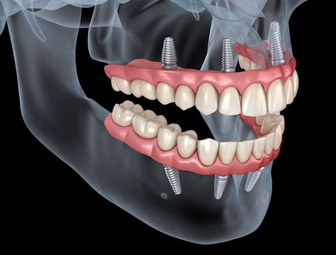 Bestseller - 3d dental animation dental animation 3d surgery animation 3d medical animation