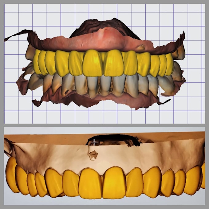 Bestseller - design all kind of dental prosthesis using exocad