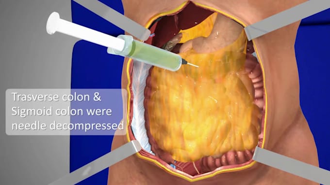 Gig Preview - Create 3d medical animation 3d surgical process 3d medical anatomy modelling