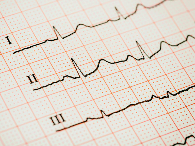 Gig Preview - Interpret any ecg and teach ecg interpretation