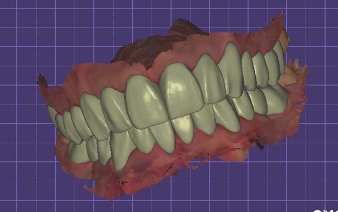 Gig Preview - Do dental cadcam 3d designs such as crowns and bridges