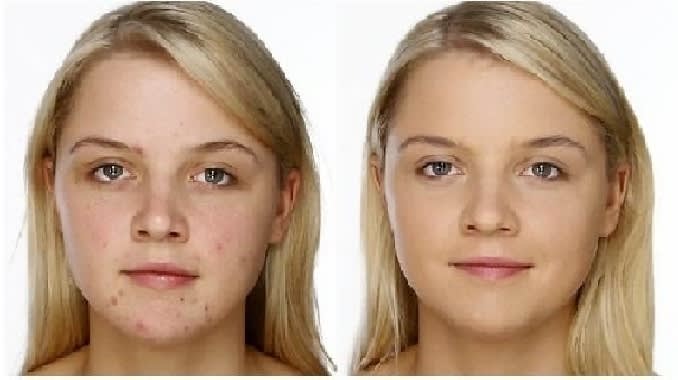 угри в 16 лет у девушки угри в 16 лет у девушки