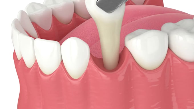 Gig Preview - Create 3d dental animation 3d surgery 3d medical animation and explainer video