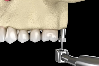 create 3d medical animation 3d dental product, medical device animation