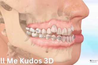 create 3d orthodontic extra oral device, headgear animation video