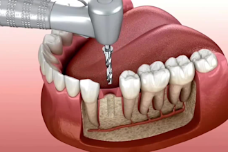 create 3d dental implant animation, medical videos and surgical procedure c4d
