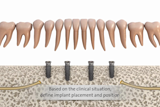 do 3d dental animation 3d dental implant 3d medical device