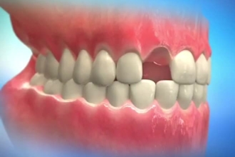 do realistic 3d dental animation 3d medical video veneer teeth implant animation
