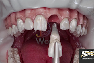 create 3d medical dental implant animation video dental procedure medical video