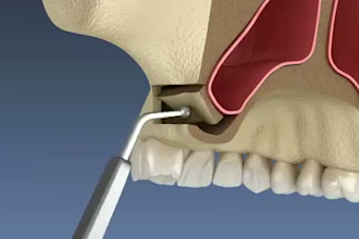 realistic 3d dental animation 3d surgical explainer video 3d medical animation
