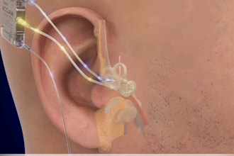 create 3d medical animation medical explainer ear surgical procedure animation