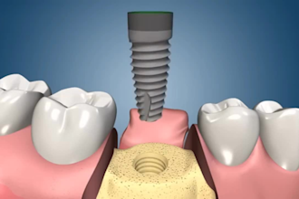 3d dental explanier animation 3d surgical animation 3d medical animation video