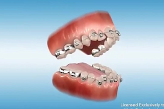 do 3d surgical animation video 3d dental illustration 3d medical animation