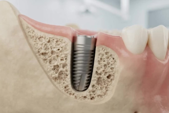 create 3d dental implant animation and medical explainer video
