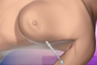 do 3d medical animation, medical animation video, anaesthetic brain surgery