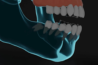 create realistic 3d medical animation dental implant orthodontic teeth visual