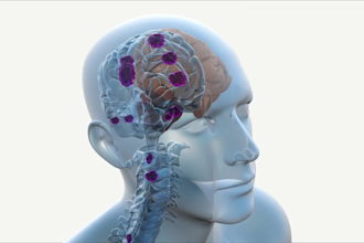 create 3d animation of brain tumor, spinal cord tumor anatomy, 3d medical videos