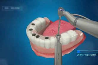 create 3d dental implant, bone graft and oral treatment surgery animation video