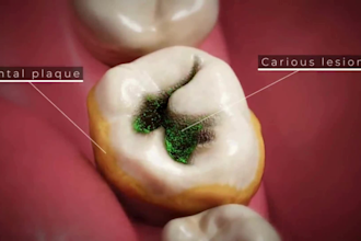create 3d medical animation tooth anatomy gum disease dental implant procedure