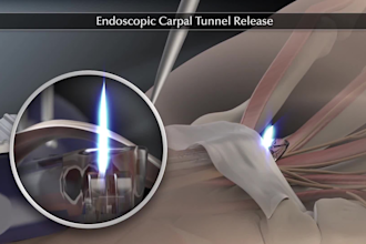 do 3d orthopedic animation 3d surgery animation  medical device explainer video