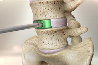 cgi 3d medical animation video surgery 3d product animation 3d medical modeling