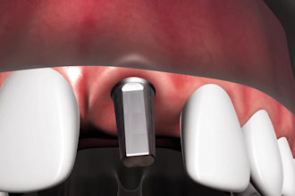 create professional dental implant and crown 3d animation video