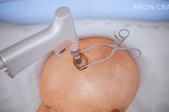 do 3d surgical animation 3d medical animation surgery animation 3d animation
