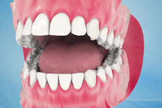 do 3d medical animation implantology oral surgery explainer video medical device