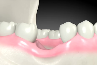 create realistic 3d dental implant oral surgery  medical animation video