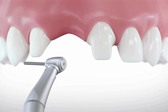create 3d dental animation, 3d dental implant animation, oral surgery animation