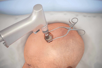 create realistic 3d medical animations 3d neurosurgery brain anatomy animation