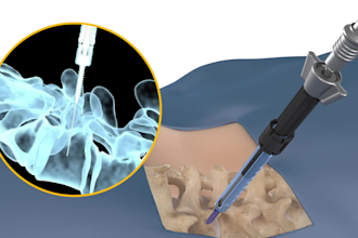 create3d medical device animation spine surgery orthopedic implant visualization