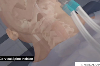 create 3d medical animation, 3d medical device animation, 3d anatomy animation