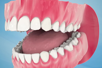 create 3d dental implant animation teeth surgery procedure medical anatomy video