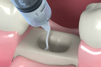 create 3d dental implant animation oral surgery animation dental procedure video
