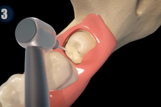 do 3d dental implant animation 3d dental procedure 3d medical explainer video