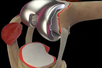 realistic 3d medical animation for product or procedure 3d explainer body video