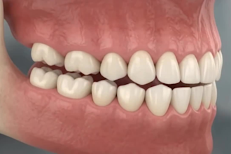 create realistic 3d dental implant animation, medical explainer video