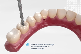 create 3d medical animation 3d dental implant procedure 3d dental surgery video