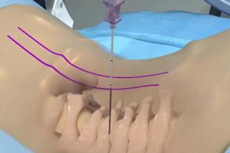 create 3d medical animation surgical animation surgical procedure video