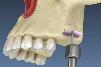 create 3d medical animation dental implant surgery animation tooth implant video