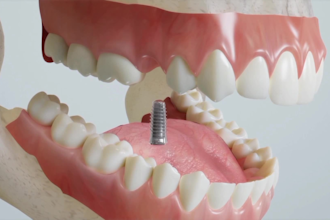 create 3d dental animation  surgery dental implant video and tooth model video