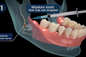 do 3d dental animation 3d dental procedure animation 3d dental implant video