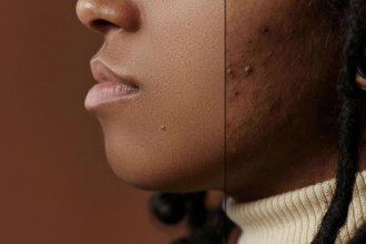 do skin retouching using photoshop, removing acne