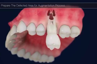 create 3d medical animation dental animation 3d surgery animation medical video