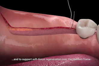 create 3d medical dental implant animation video  dental procedure medical video