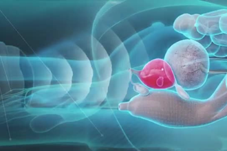 do 3d medical animation, medical animation, 3d medical device, surgery animation