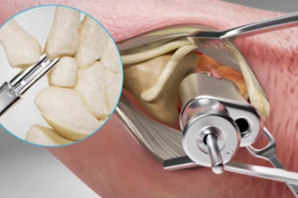 do 3d medical animation video, medical animation, surgery animation 3d animation