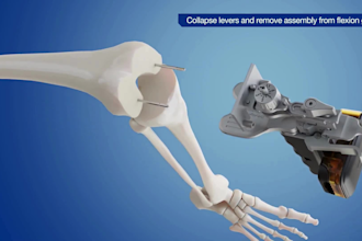 create 3d orthopedic surgery animation knee replacement animation medical device