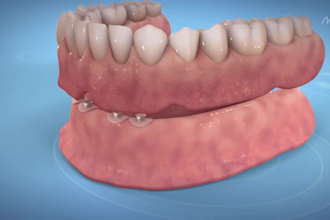 create 3d dental implant animation surgery procedure tooth implant medical video